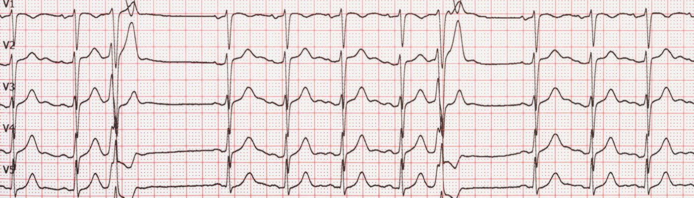 Electrocardiogram reading